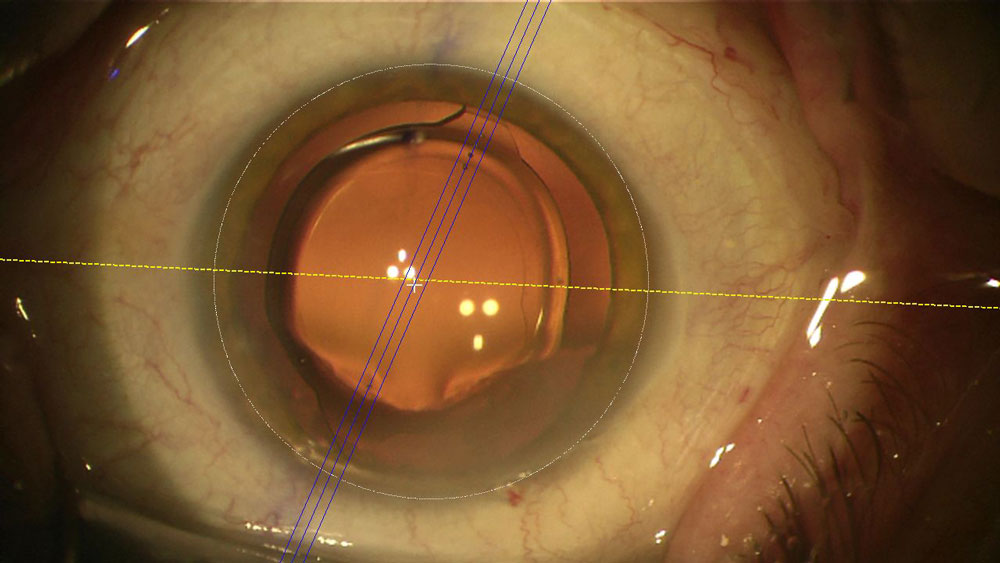 Abbildung einer Linse Torische-IOL