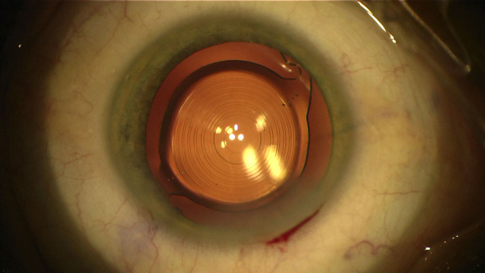 Abbildung einer Linse Torische-MF-IOL